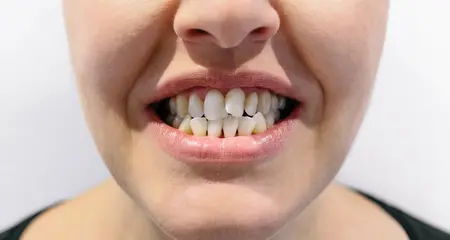 Dental Crowding