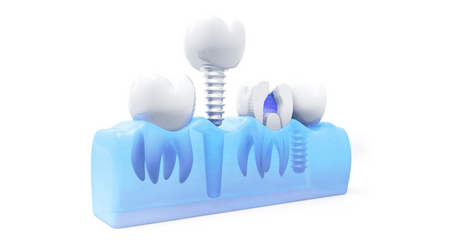 Dental Implants