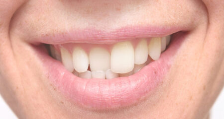Dental misalignment