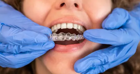 Invisalign therapy