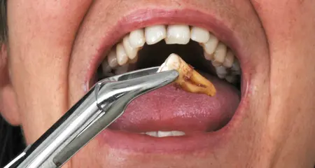 Tooth extraction