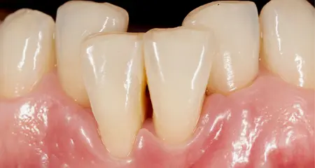 What is Dental Crowding