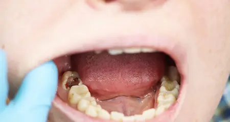cavity