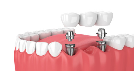 dental bridges