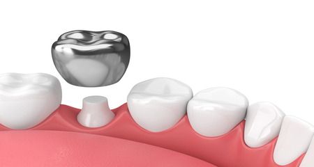dental crowns