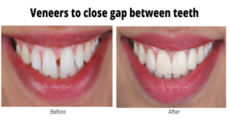 dental veneers