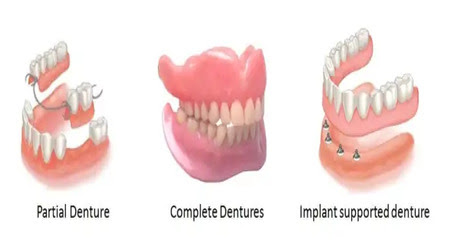 dentures