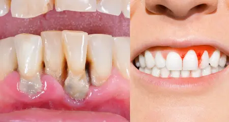 periodontal diseases