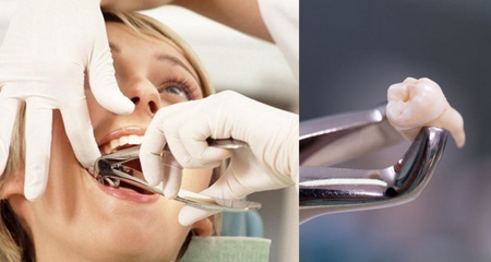 wisdom tooth extraction