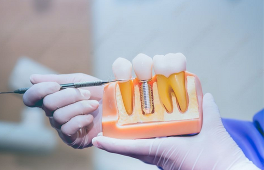 dental Implants