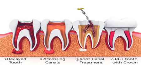 Root Canal Treatment- steps