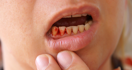 trauma or injury to gums