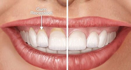 gum-grafting-before-after