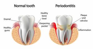 periodontis-diseases