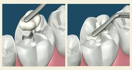 dental-composite-filling