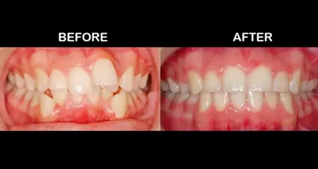 crowding teeth treatment- before- after